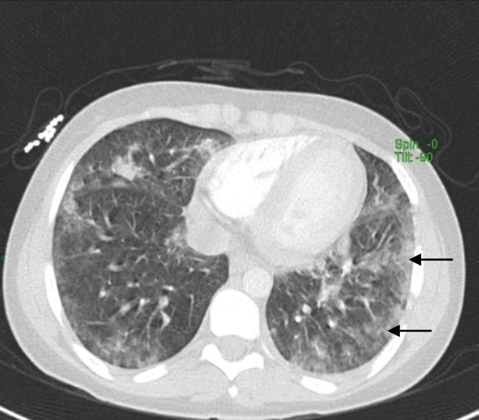 Acute Eosinophilic Pneumonia After Vaping: What is This Lung Problem and Why Happen?