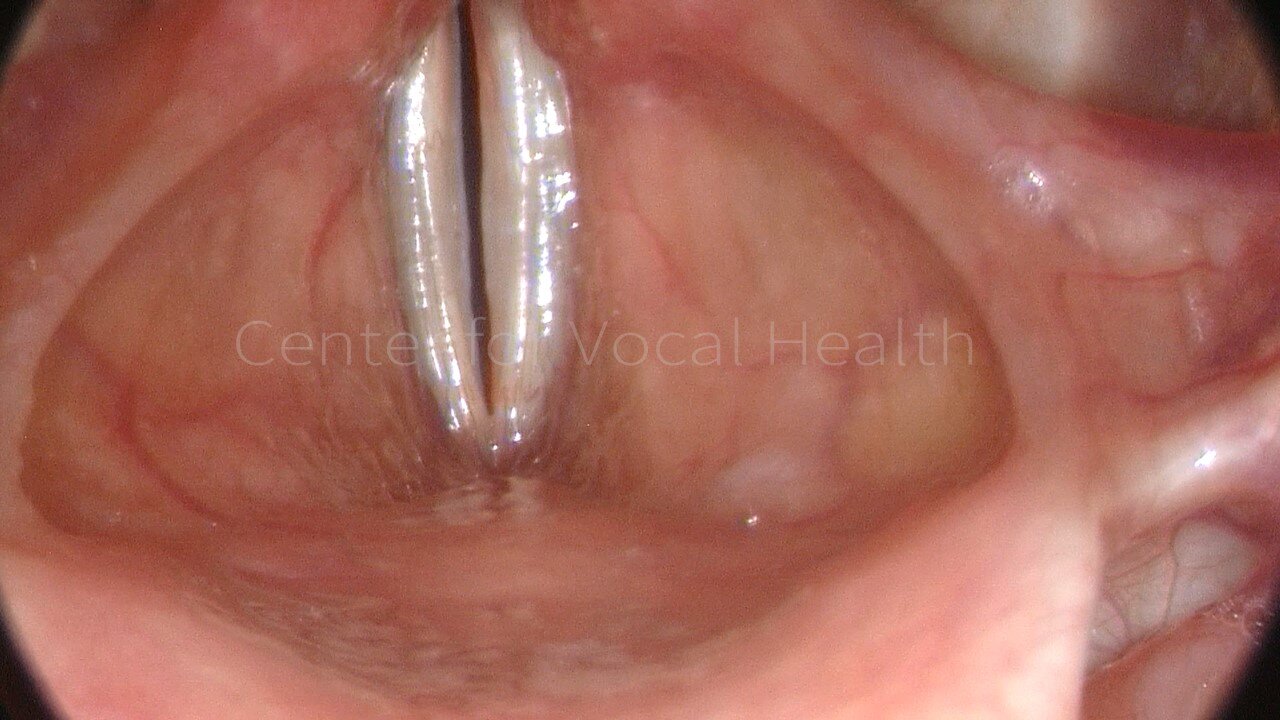 Vaping Hurt Your Singing? Find Out How E-Cigs Damage Voices