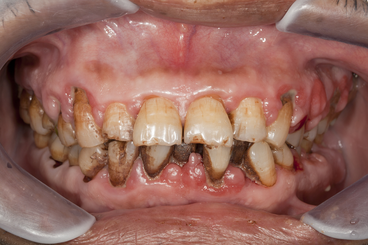 Teeth Damage from Vaping? How Electronic Cigarettes Really Affect You